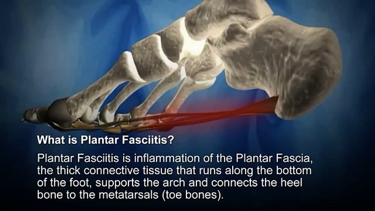 Best Plantar Fasciitis Treatment Denver - 303-974-4440 - Dr. Bradley Bosick D.C.