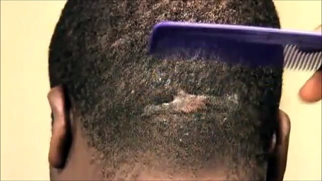 Blackheads, Pimples, Keloid Scars, Sebaceous Cysts and Rosacea YouTube