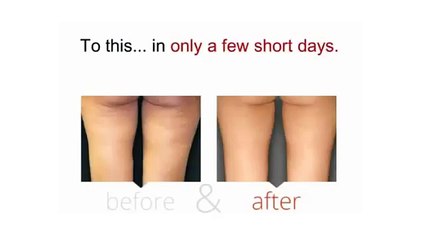 Cellulite Factor Review - What To Expect