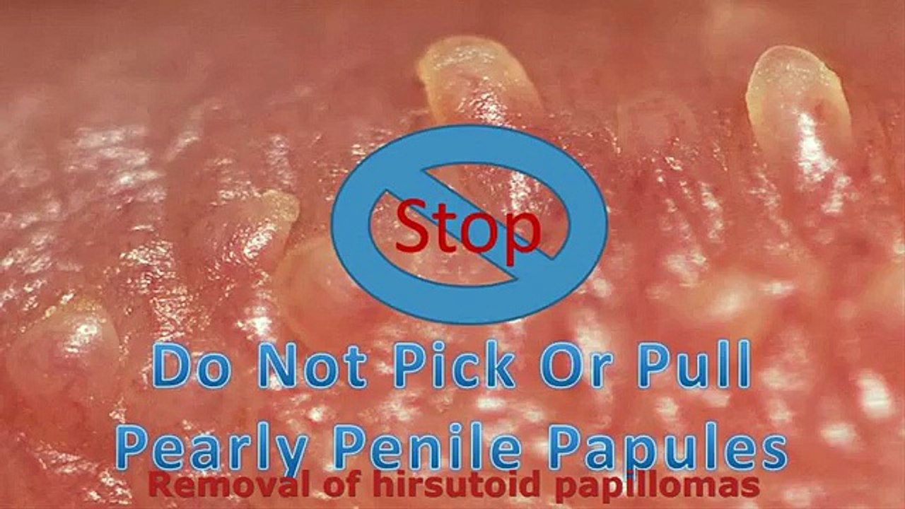 Penis papules in Genital Papules