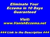Susan Clark's Beat Eczema - This All Natural Formula Will Clear Your Eczema For Good