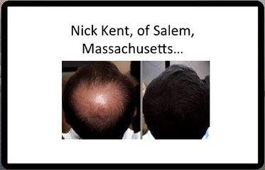 Hair Loss Protocol Rewiev