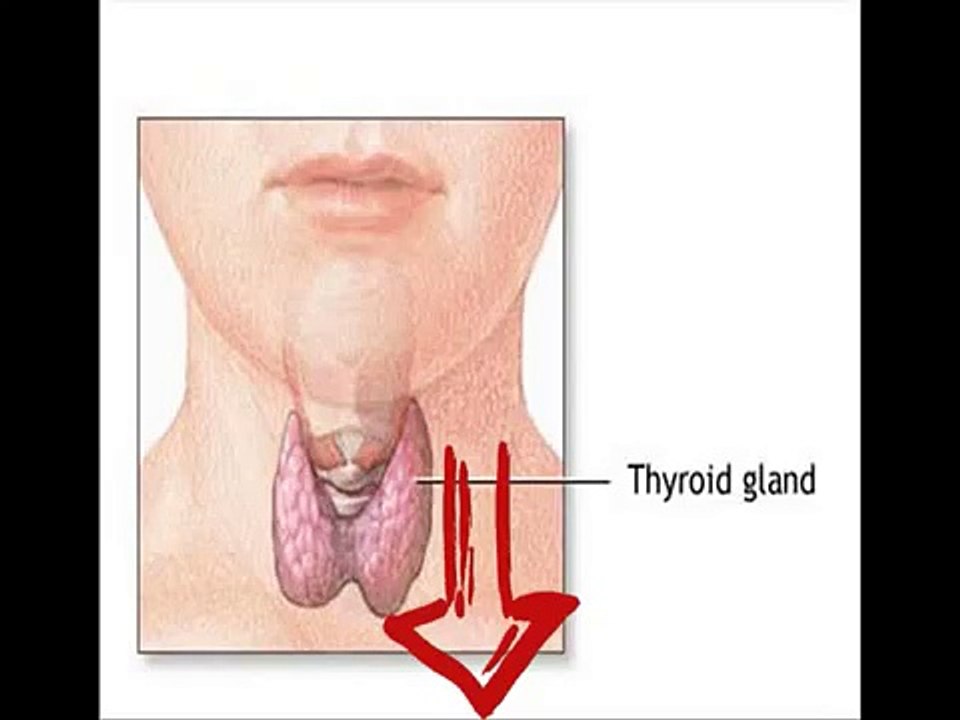 Hypothyroidism Revolution