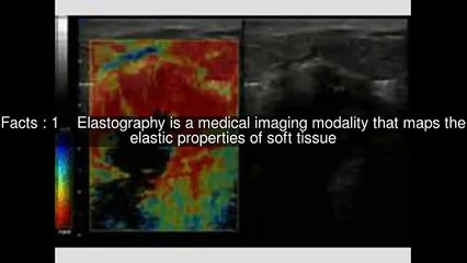 Elastography Top  #5 Facts (1024p FULL HD)