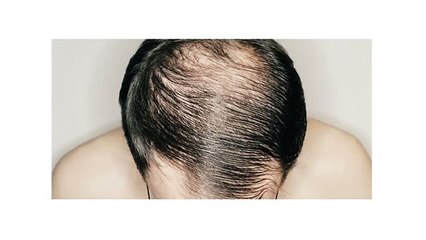 Hair Loss Protocol Review
