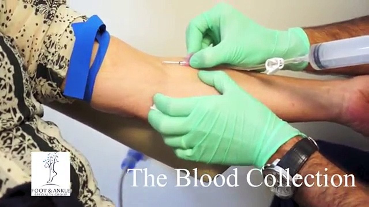PRP Platelet Rich Plasma Therapy for Plantar Fasciitis, Heel Pain