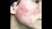 8 Remedios caseros y naturales para la rosacea - Sintomas y Causas