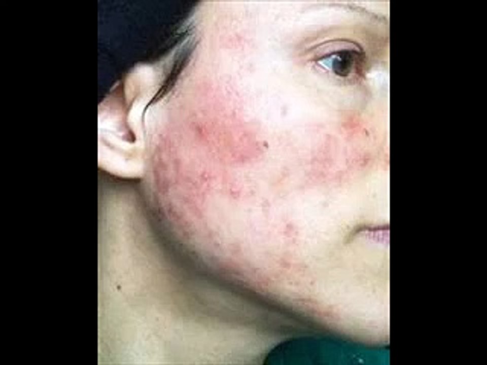 8 Remedios caseros y naturales para la rosacea - Sintomas y Causas