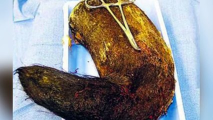 10 Craziest Things Found In Peoples Bodies