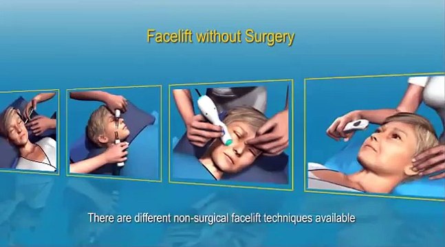 Facelift without Surgery
