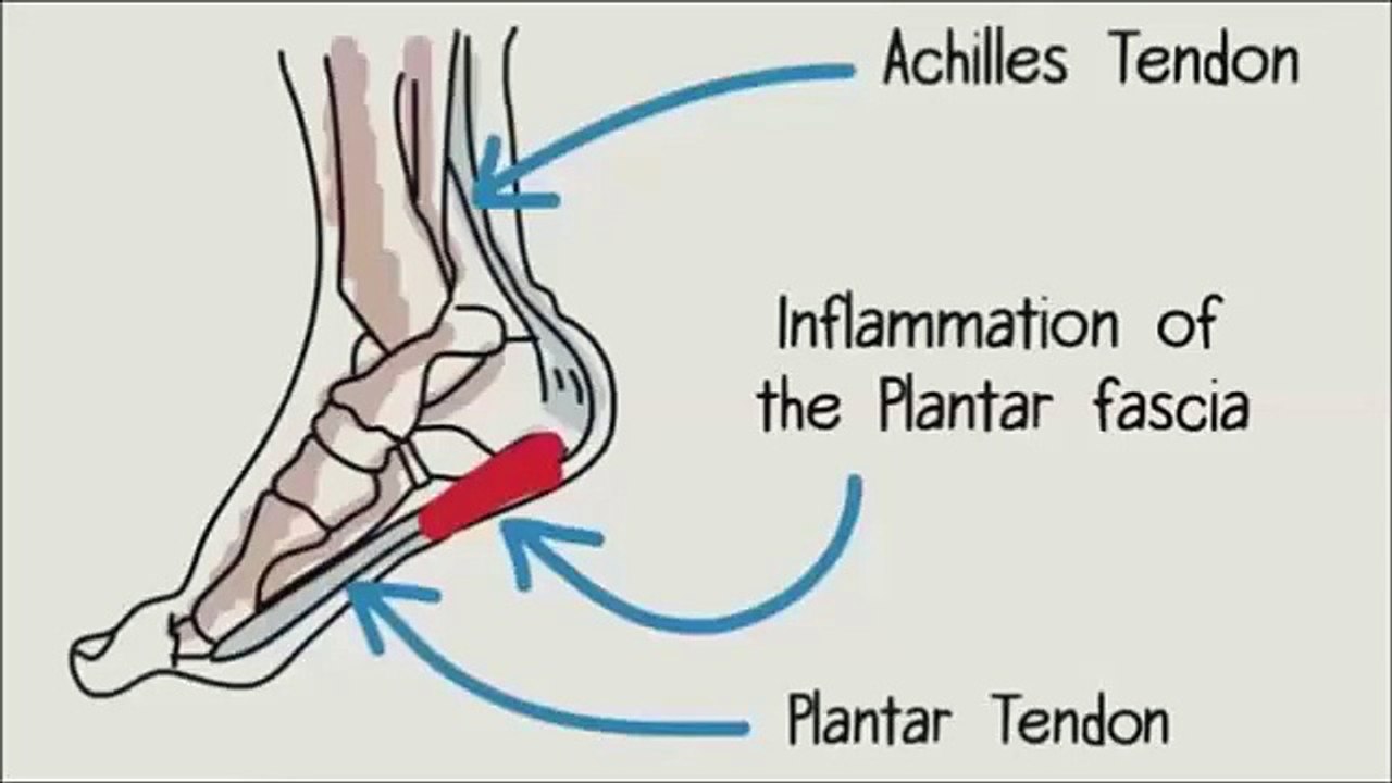 Fast Plantar Fasciitis Cure - Part 2