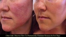 4 symptoms of rosacea | Rosacea natural treatment