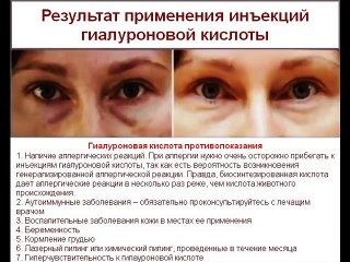 Гиалуроновая кислота противопоказания,  гиалуроновая кислота губы, применение гиалуроновой кислоты