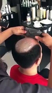 Protez Saç Nasıl Uygulanır Yok Böyle Bir Şey