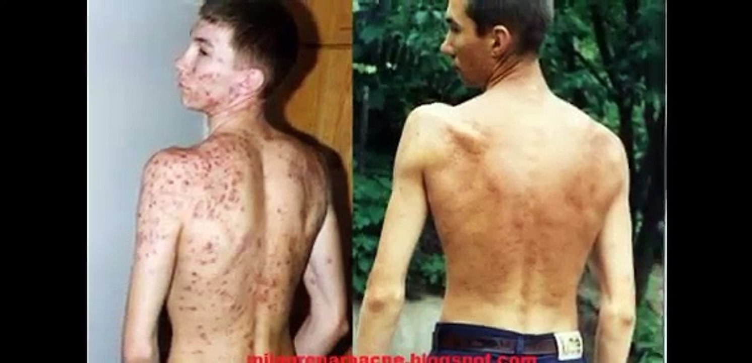 Milagre Para A Acne Funciona: Testemunhos