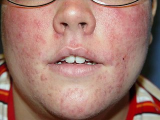 Dr. Darm Aesthetic Medicine - Rosacea