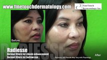 Facelift Without Surgery for Cheeks and Eye Hollows: Radiesse Results for Beverly Hills Patient