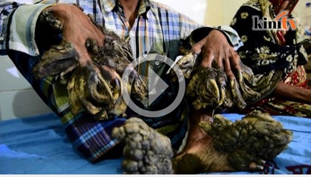 'Lelaki pokok' jalani proses bedah 6 bulan