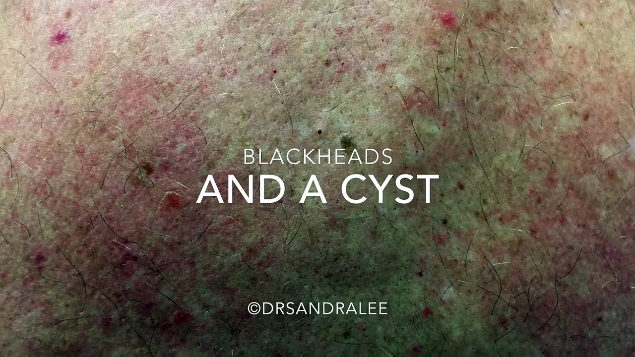 A neverending cyst and blackheads extracted