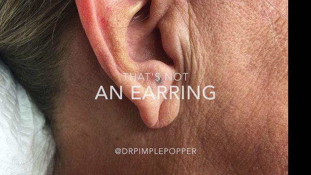 A nice earlobe blackhead extracted