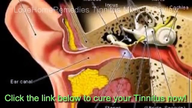 Tinnitus Miracle Review - Does Tinnitus Miracle Really Work or is it a Scam?