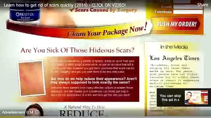 Rosacea - 10 Tips For Treatment [Rosacea Treatment]