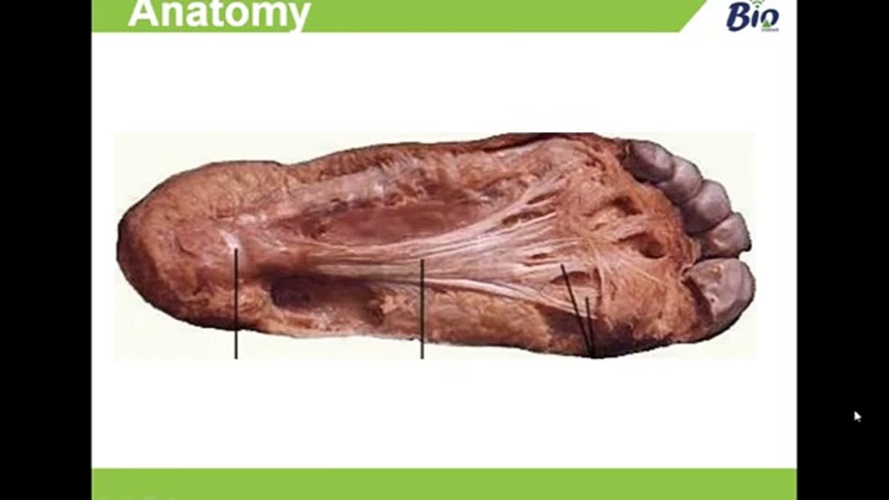 Plantar Fasciitis - Anatomy, Causes & Management