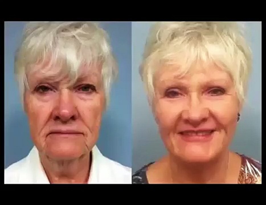 Facelift without Surgery