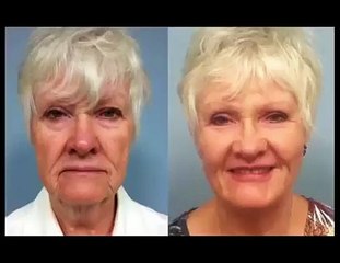 Facelift without Surgery