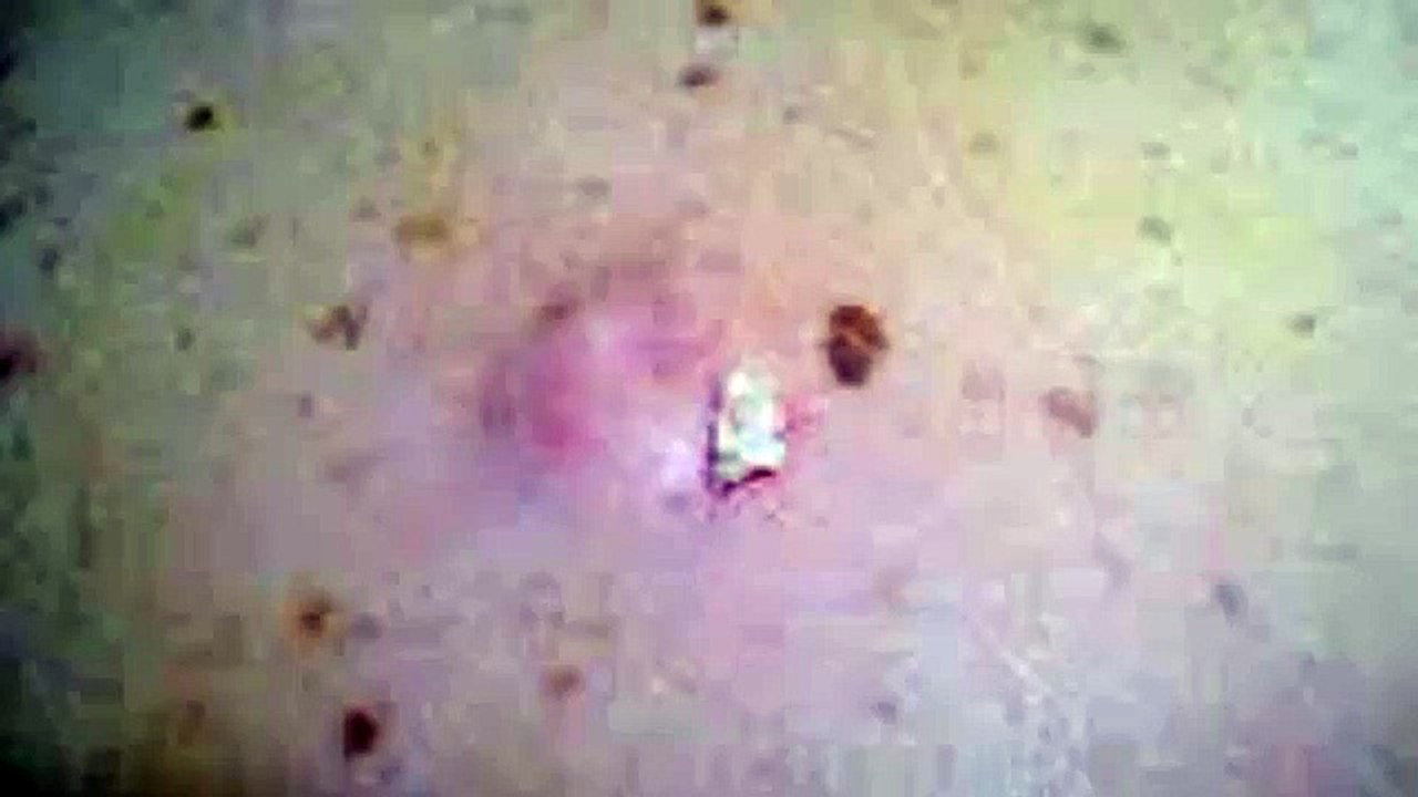 Hidradenitis Suppurativa Cure