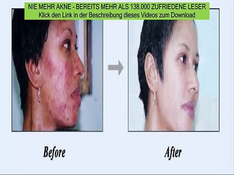 akne produkte - pickel bekämpfen mit hausmittel - nie mehr akne erfahrung