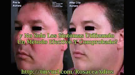 Rosacea Tratamiento Topico | Descubre Como Librarte De La Rosácea De Forma Rápida