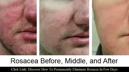 Treat your own rosacea | Rosacea remedies