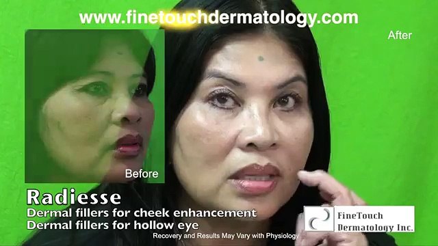 Facelift Without Surgery: After Nonsurgical Cheek Enhancement on Glendale Patient