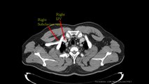 Major Thoracic Vessels - Venous