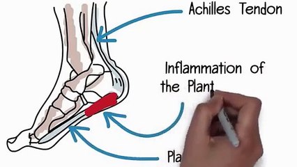 Plantar Fasciitis Treatment | Fast Plantar Fasciitis Cure | bunion treatment