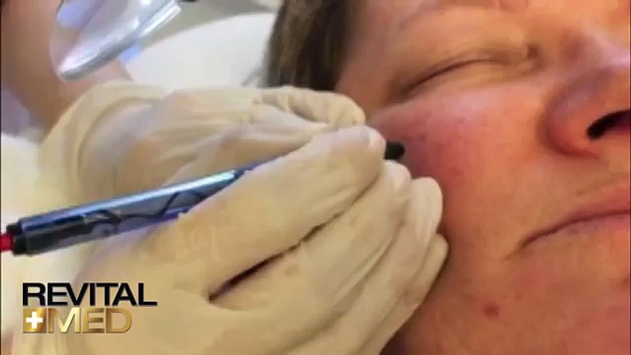 Rosacea kezelés VIRIDEX-el (RevitalMed)