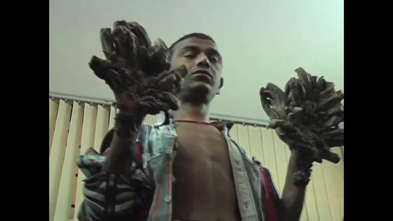 ツリーマンと呼ばれた男 ついに手術を決意 Video Dailymotion