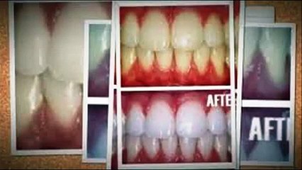 Teeth Whitening Miracle | Teeth Whitening Miracle Review