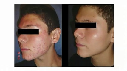 Milagro Para El Acne | Realmente Funciona? Averigualo Aqui!!!