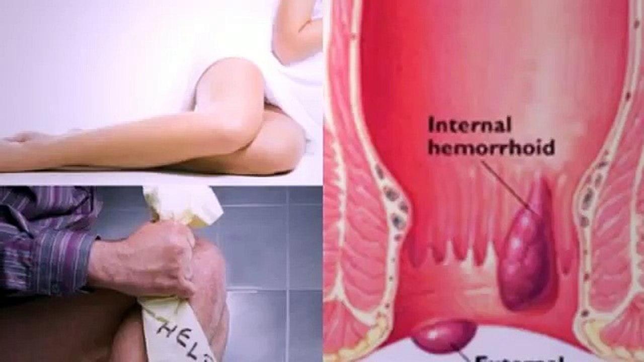 Hemorrhoid No More Reviews-Is It Worth It?