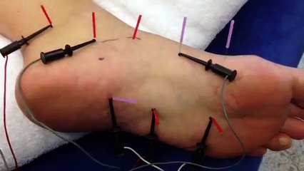 Dry Needling for Plantar Fasciitis | Dry Needling Courses, Dry Needling Certification: Done in Italy