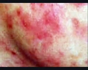 Rosacea Cure?