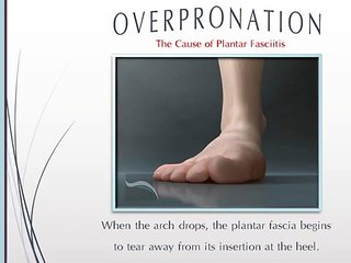 Plantar Fasciitis: One Cause, One Cure