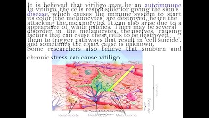 Natural Vitiligo Treatment System PDF | A Guide On Vitiligo Natural Treatments