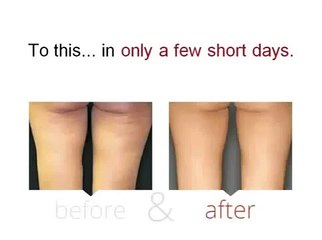 Cellulite Factor Review - Reduce Cellulite Permanently
