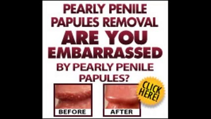 Pearly Penile Papules Removal Review | Amazing Pearly Penile Papules Removal Review By Josh Marvin