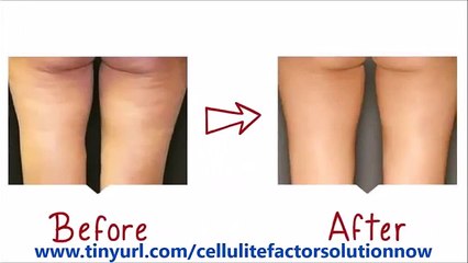 Cellulite Factor Solution System | Amazing Cellulite Factor Solution System By Charles Livingston
