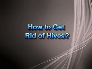 How To Get Rid of Hives? | Treat it with Dr. Gary Levin&#39;s natural treatment
