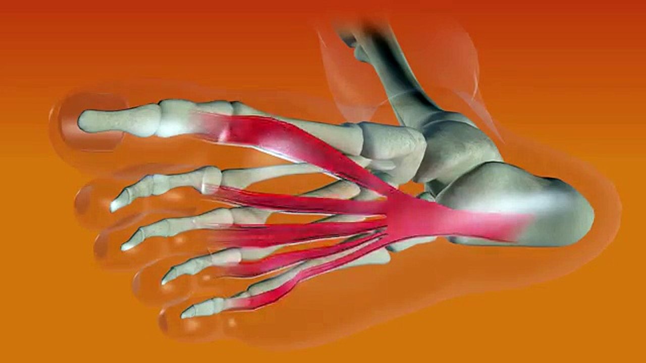 What is Plantar Fasciitis? How to quickly and easily relieve heel pain!